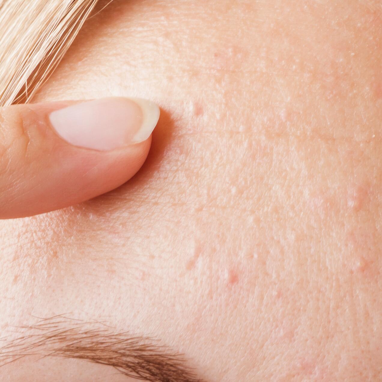 Kystes et Microkystes acné